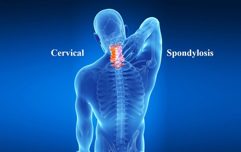 Cervical Spondylosis Physiotherapy