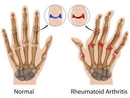 Rheumatoid Arthritis Physiotherapy