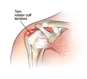 Rotator Cuff Injury Treatment