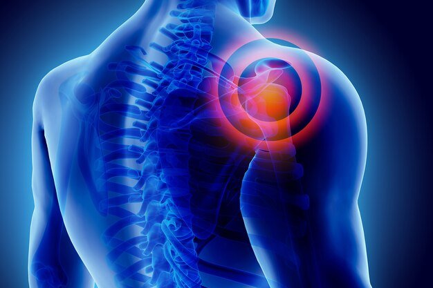 Periarthritis of Shoulder Joint (Frozen Shoulder) Treatment