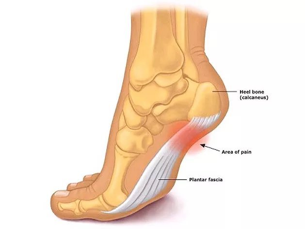 Plantar Fasciitis Treatment